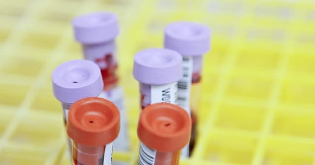 Hoffnungsträger: neuer Test sagt Alzheimer voraus